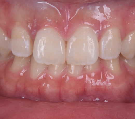 すきっ歯に対する治療後